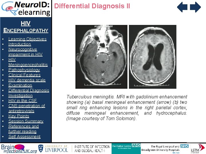 Differential Diagnosis II HIV ENCEPHALOPATHY • • • • Learning Objectives Introduction Neurocognitive impairment
