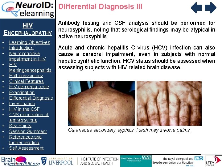 Differential Diagnosis III HIV ENCEPHALOPATHY • • • • Learning Objectives Introduction Neurocognitive impairment
