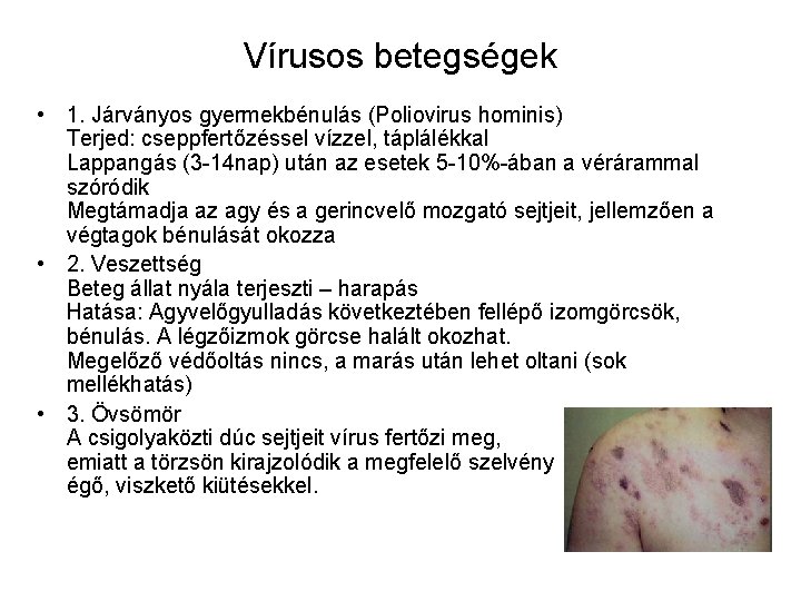 Vírusos betegségek • 1. Járványos gyermekbénulás (Poliovirus hominis) Terjed: cseppfertőzéssel vízzel, táplálékkal Lappangás (3