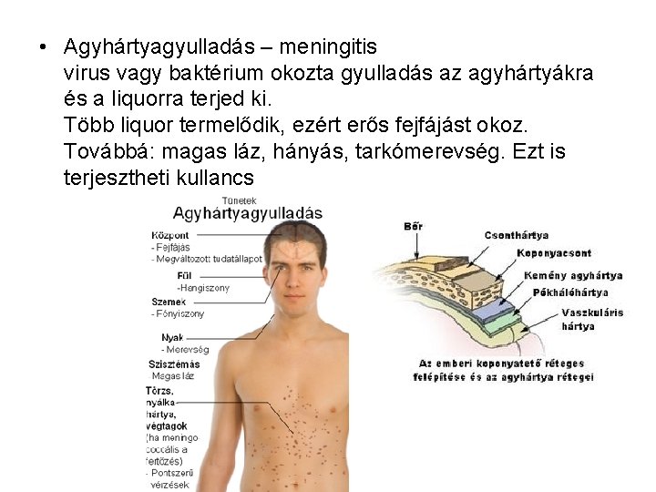  • Agyhártyagyulladás – meningitis virus vagy baktérium okozta gyulladás az agyhártyákra és a