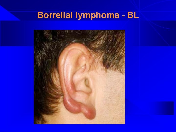 Borrelial lymphoma - BL 