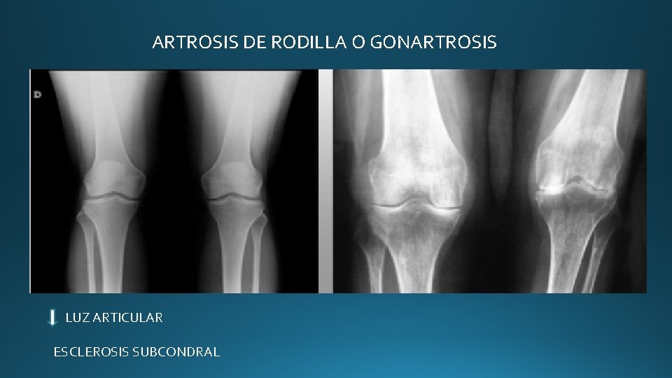 ARTROSIS DE RODILLA O GONARTROSIS LUZ ARTICULAR ESCLEROSIS SUBCONDRAL ARTROSIS DE RODILLA O GONARTROSIS LUZ ARTICULAR ESCLEROSIS SUBCONDRAL