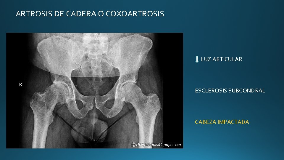 ARTROSIS DE CADERA O COXOARTROSIS LUZ ARTICULAR ESCLEROSIS SUBCONDRAL CABEZA IMPACTADA ARTROSIS DE CADERA O COXOARTROSIS LUZ ARTICULAR ESCLEROSIS SUBCONDRAL CABEZA IMPACTADA