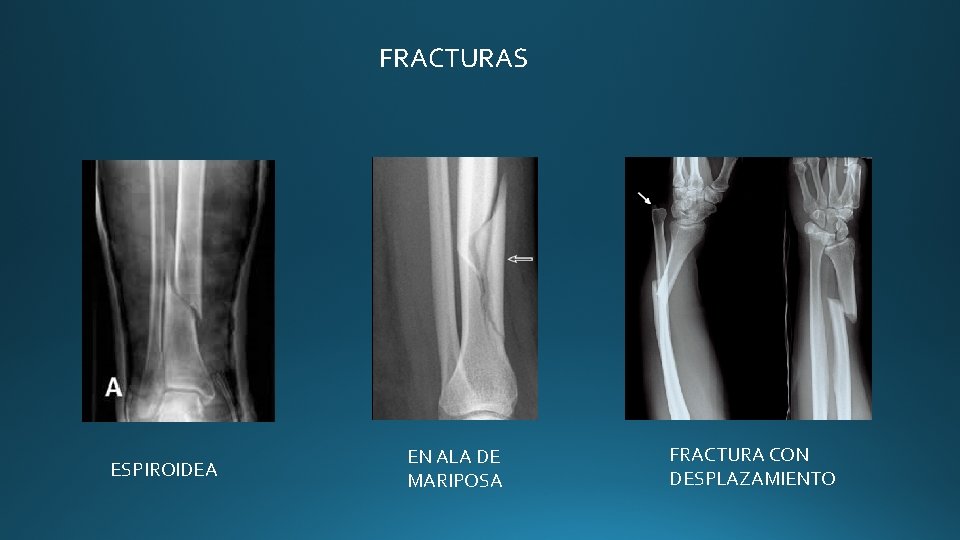 FRACTURAS ESPIROIDEA EN ALA DE MARIPOSA FRACTURA CON DESPLAZAMIENTO FRACTURAS ESPIROIDEA EN ALA DE MARIPOSA FRACTURA CON DESPLAZAMIENTO