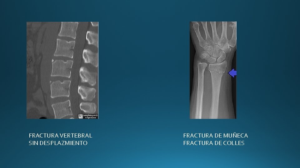 FRACTURA VERTEBRAL SIN DESPLAZMIENTO FRACTURA DE MUÑECA FRACTURA DE COLLES FRACTURA VERTEBRAL SIN DESPLAZMIENTO FRACTURA DE MUÑECA FRACTURA DE COLLES