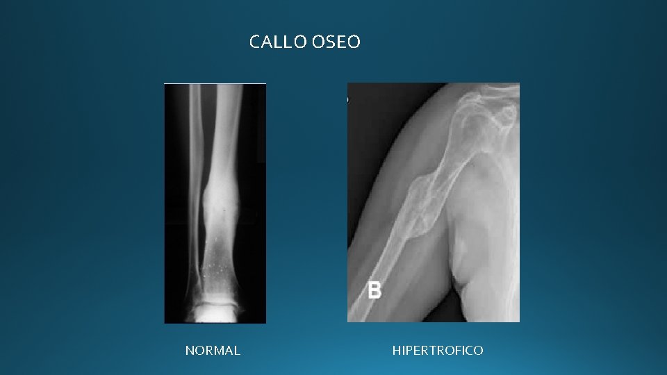 CALLO OSEO NORMAL HIPERTROFICO CALLO OSEO NORMAL HIPERTROFICO