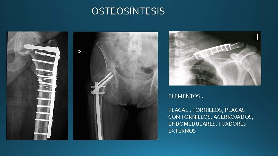 OSTEOSÍNTESIS ELEMENTOS : PLACAS , TORNILLOS, PLACAS CON TORNILLOS, ACERROJADOS, ENDOMEDULARES, FIJADORES EXTERNOS OSTEOSÍNTESIS ELEMENTOS : PLACAS , TORNILLOS, PLACAS CON TORNILLOS, ACERROJADOS, ENDOMEDULARES, FIJADORES EXTERNOS