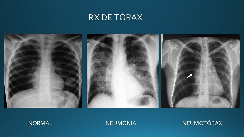 RX DE TÓRAX NORMAL NEUMONIA NEUMOTÓRAX RX DE TÓRAX NORMAL NEUMONIA NEUMOTÓRAX