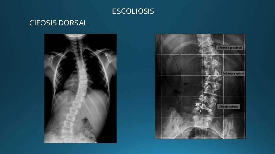 ESCOLIOSIS CIFOSIS DORSAL ESCOLIOSIS CIFOSIS DORSAL