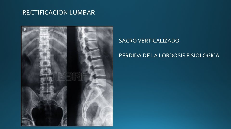 RECTIFICACION LUMBAR SACRO VERTICALIZADO PERDIDA DE LA LORDOSIS FISIOLOGICA RECTIFICACION LUMBAR SACRO VERTICALIZADO PERDIDA DE LA LORDOSIS FISIOLOGICA
