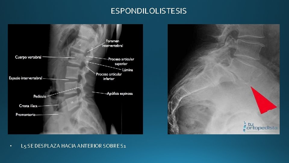 ESPONDILOLISTESIS • L 5 SE DESPLAZA HACIA ANTERIOR SOBRE S 1 ESPONDILOLISTESIS • L 5 SE DESPLAZA HACIA ANTERIOR SOBRE S 1