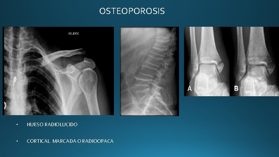 OSTEOPOROSIS • HUESO RADIOLUCIDO • CORTICAL MARCADA O RADIOOPACA OSTEOPOROSIS • HUESO RADIOLUCIDO • CORTICAL MARCADA O RADIOOPACA