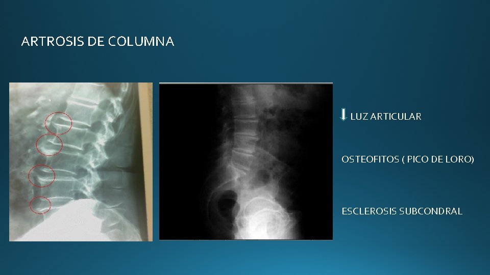 ARTROSIS DE COLUMNA LUZ ARTICULAR OSTEOFITOS ( PICO DE LORO) ESCLEROSIS SUBCONDRAL ARTROSIS DE COLUMNA LUZ ARTICULAR OSTEOFITOS ( PICO DE LORO) ESCLEROSIS SUBCONDRAL