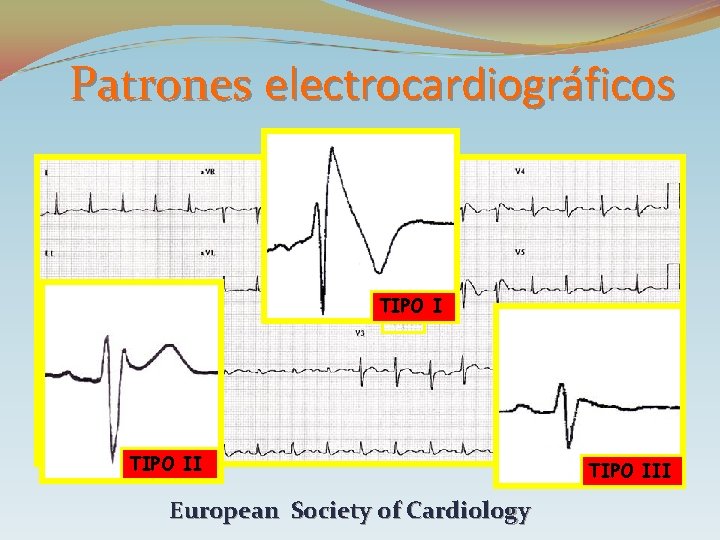 Patrones electrocardiográficos TIPO II European Society of Cardiology TIPO III 