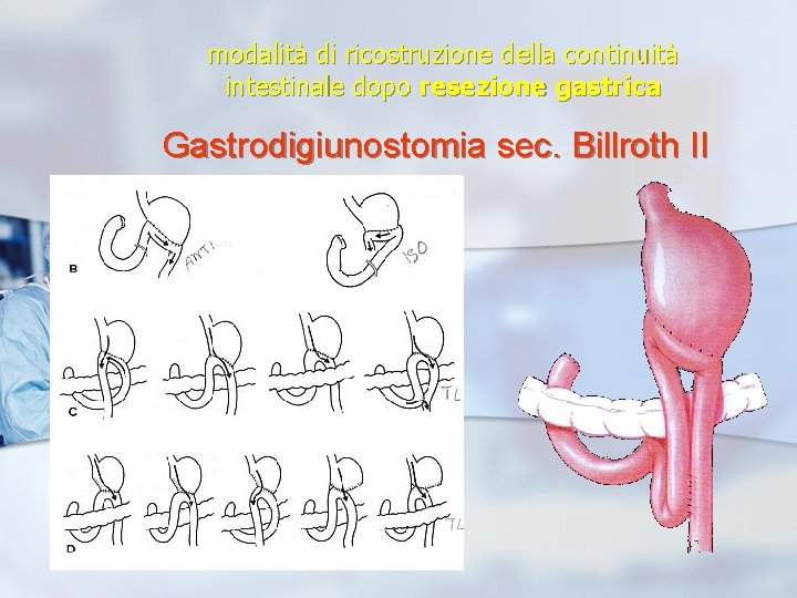 modalità di ricostruzione della continuità intestinale dopo resezione gastrica Gastrodigiunostomia sec. Billroth II 