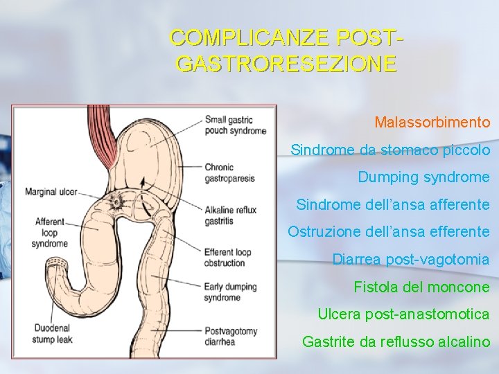 COMPLICANZE POSTGASTRORESEZIONE Malassorbimento Sindrome da stomaco piccolo Dumping syndrome Sindrome dell’ansa afferente Ostruzione dell’ansa