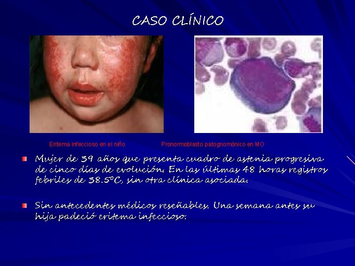 CASO CLÍNICO Eritema infeccioso en el niño Pronormoblasto patognomónico en MO Mujer de 39