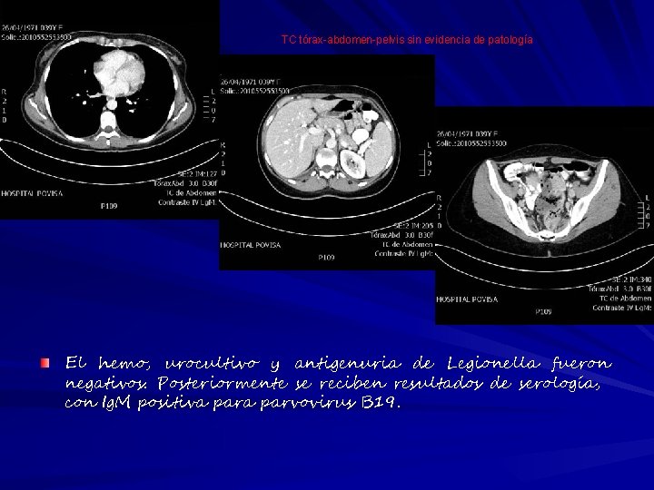 TC tórax-abdomen-pelvis sin evidencia de patología El hemo, urocultivo y antigenuria de Legionella fueron