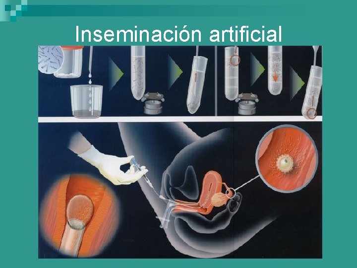 Inseminación artificial 