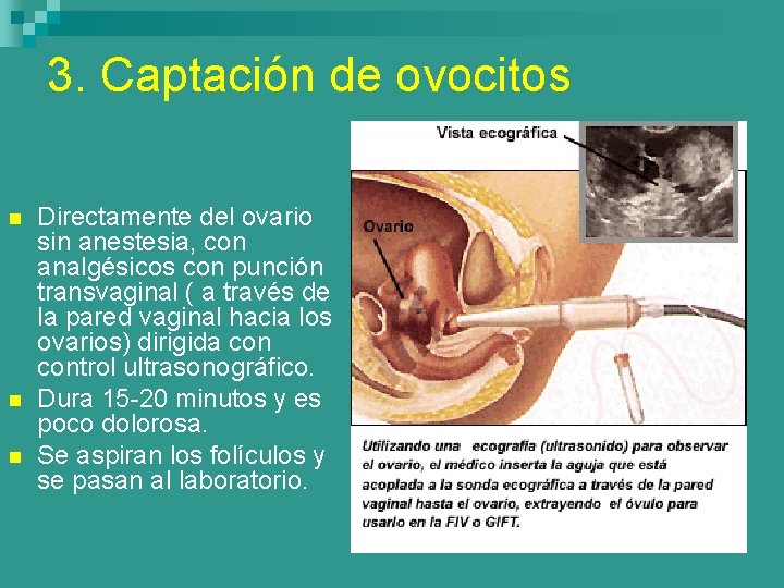 3. Captación de ovocitos n n n Directamente del ovario sin anestesia, con analgésicos