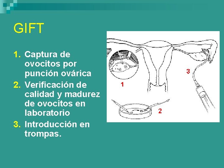 GIFT 1. Captura de ovocitos por punción ovárica 2. Verificación de calidad y madurez