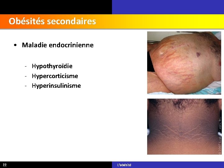 Obésités secondaires • Maladie endocrinienne - Hypothyroïdie - Hypercorticisme - Hyperinsulinisme 22 L’obésité 