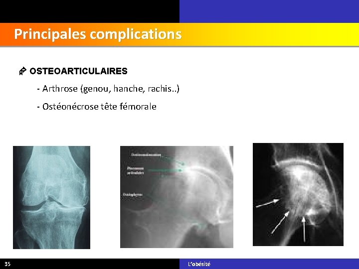 Principales complications OSTEOARTICULAIRES - Arthrose (genou, hanche, rachis. . ) - Ostéonécrose tête fémorale