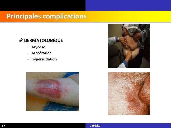 Principales complications DERMATOLOGIQUE - Mycose - Macération - hypersudation 37 L’obésité 