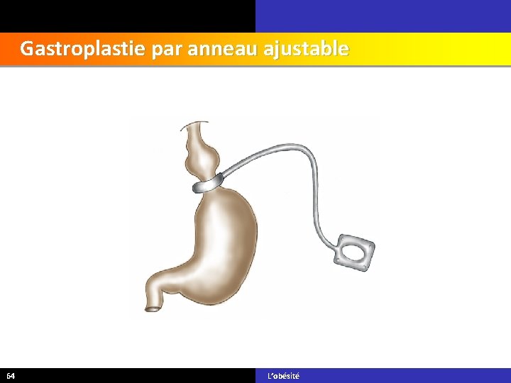 Gastroplastie par anneau ajustable 64 L’obésité 