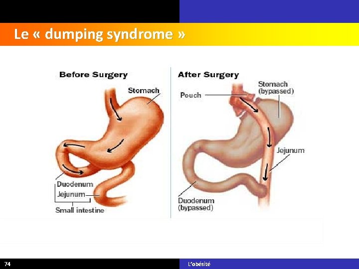 Le « dumping syndrome » 74 L’obésité 