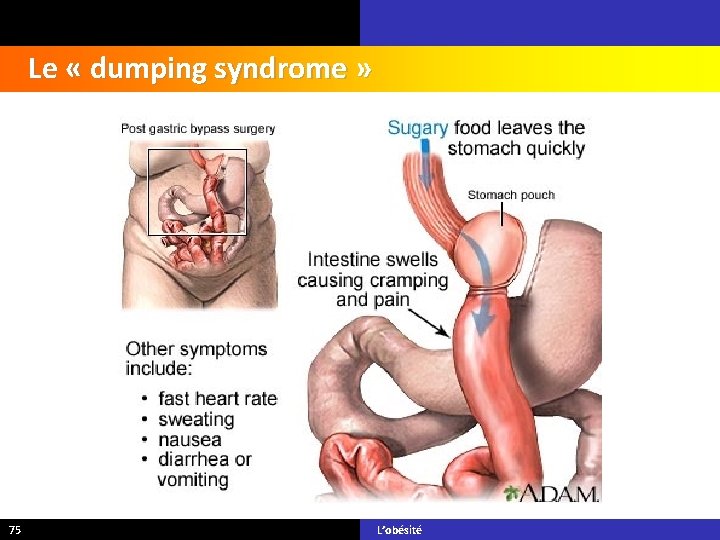 Le « dumping syndrome » 75 L’obésité 