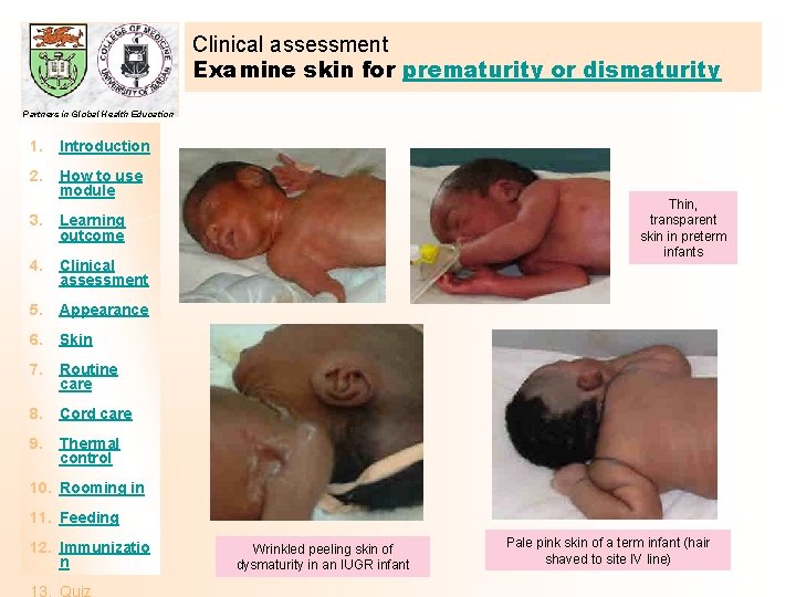 Clinical assessment Examine skin for prematurity or dismaturity Partners in Global Health Education 1.