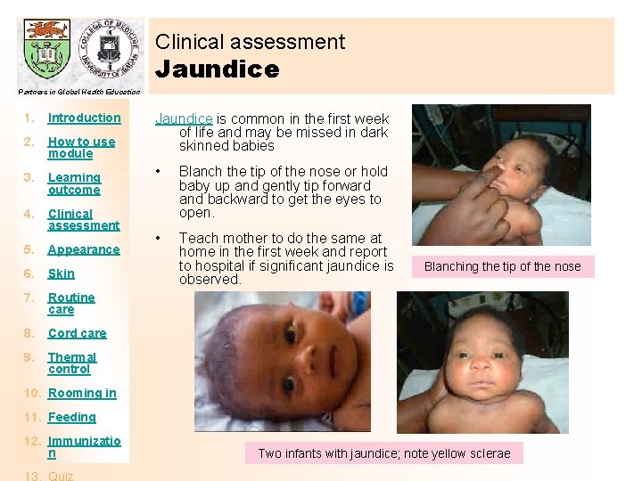 Clinical assessment Jaundice Partners in Global Health Education 1. Introduction 2. How to use