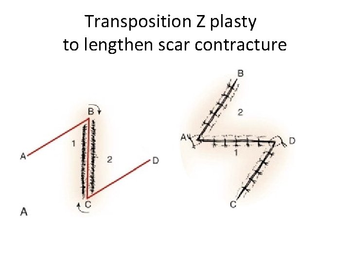 Transposition Z plasty to lengthen scar contracture 