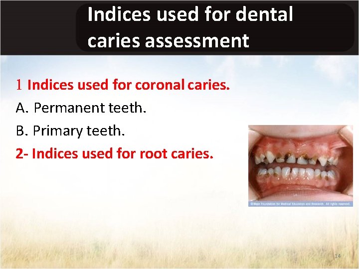 Indices used for dental caries assessment 1 Indices used for coronal caries. A. Permanent