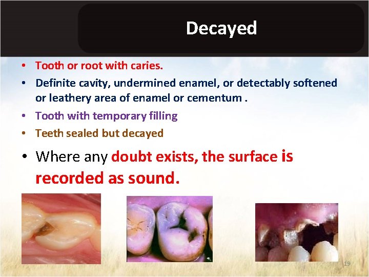Decayed • Tooth or root with caries. • Definite cavity, undermined enamel, or detectably