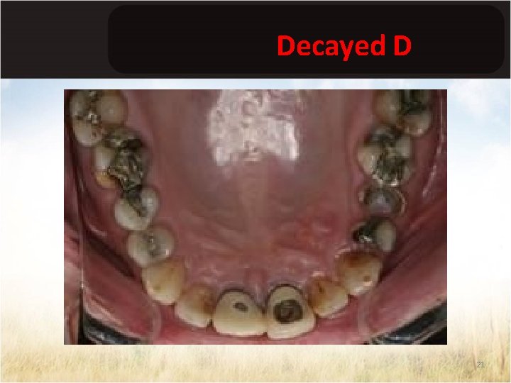 Decayed D 21 
