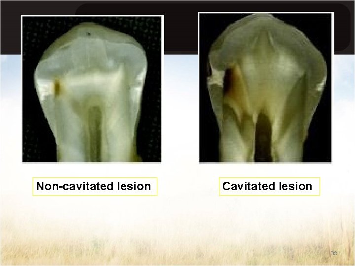 Non-cavitated lesion Cavitated lesion 38 