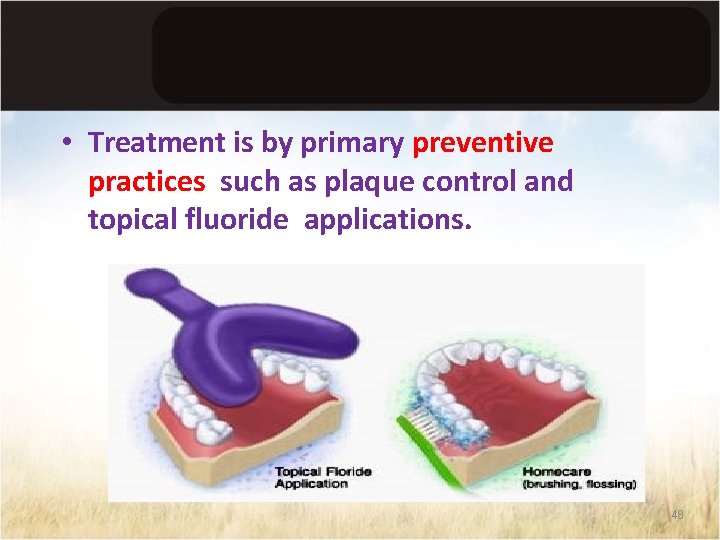 • Treatment is by primary preventive practices such as plaque control and topical