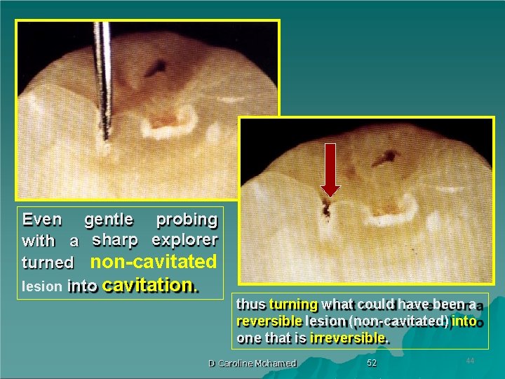 Even gentle probing with a sharp explorer turned non-cavitated lesion into cavitation. thus turning