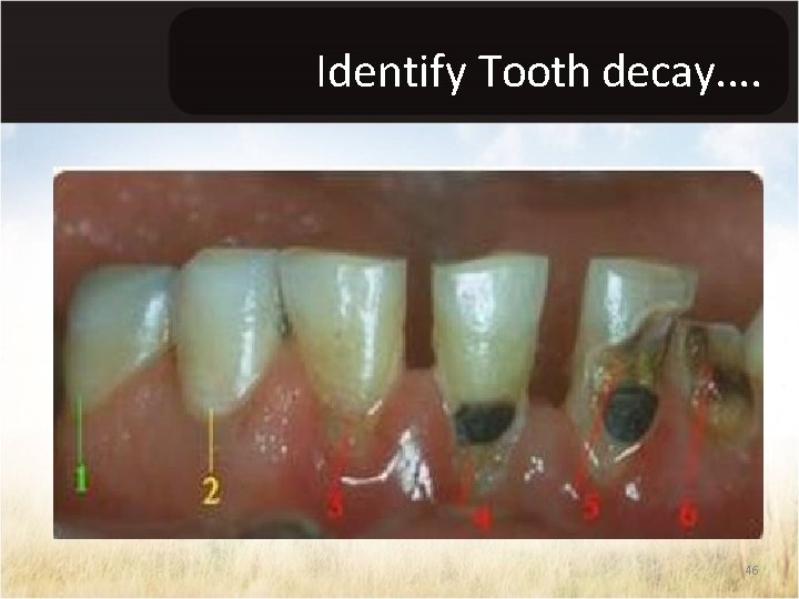 Identify Tooth decay. . 46 