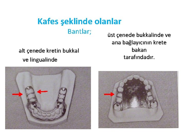 Kafes şeklinde olanlar Bantlar; alt çenede kretin bukkal ve lingualinde üst çenede bukkalinde ve