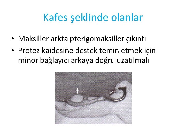 Kafes şeklinde olanlar • Maksiller arkta pterigomaksiller çıkıntı • Protez kaidesine destek temin etmek