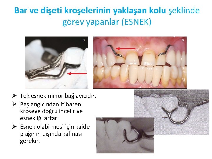 Bar ve dişeti kroşelerinin yaklaşan kolu şeklinde görev yapanlar (ESNEK) Ø Tek esnek minör