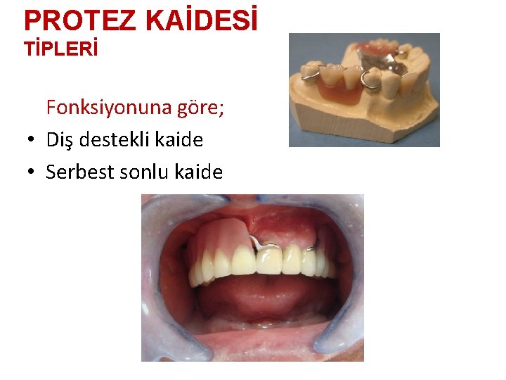 PROTEZ KAİDESİ TİPLERİ Fonksiyonuna göre; • Diş destekli kaide • Serbest sonlu kaide 