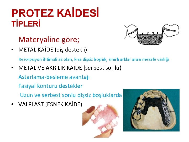 PROTEZ KAİDESİ TİPLERİ Materyaline göre; • METAL KAİDE (diş destekli) Rezorpsiyon ihtimali az olan,