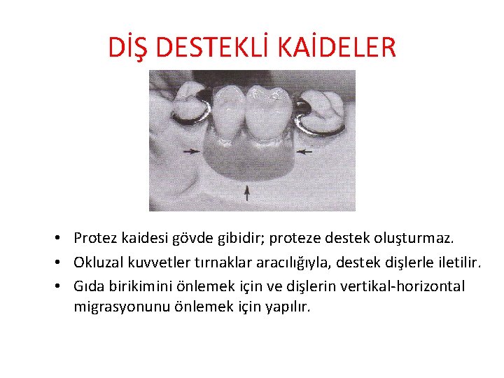 DİŞ DESTEKLİ KAİDELER • Protez kaidesi gövde gibidir; proteze destek oluşturmaz. • Okluzal kuvvetler