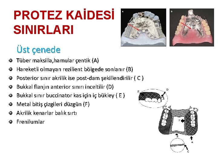 PROTEZ KAİDESİ SINIRLARI Üst çenede Tüber maksilla, hamular çentik (A) Hareketli olmayan rezilient bölgede