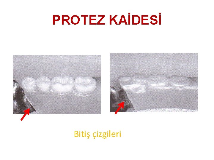 PROTEZ KAİDESİ Bitiş çizgileri 