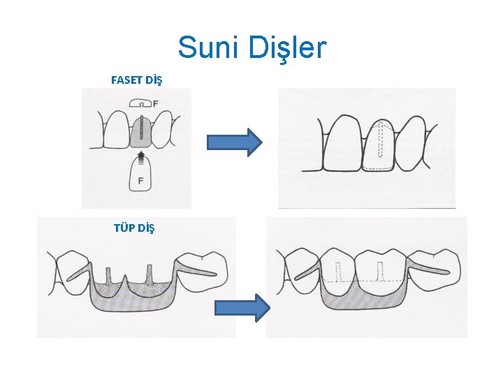 Suni Dişler FASET DİŞ TÜP DİŞ 